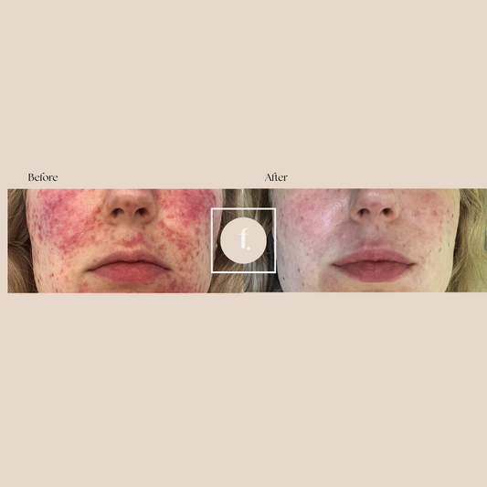 Patient Case Study: Acne Rosacea